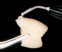 Luxatemp STAR - формирование зубного протеза